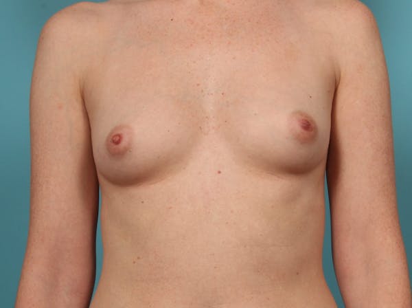 Breast Augmentation Before & After Gallery - Patient 33513197 - Image 1
