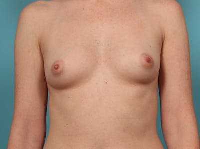 Breast Augmentation Before & After Gallery - Patient 33513197 - Image 1