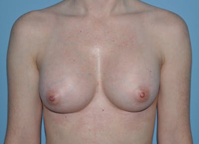 Breast Augmentation Before & After Gallery - Patient 33513197 - Image 2