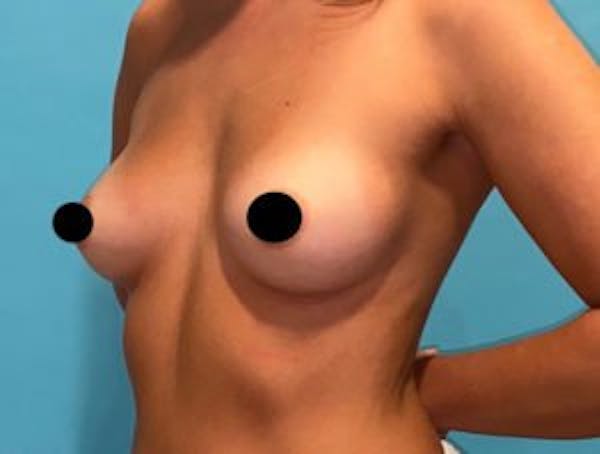 Breast Augmentation Gallery - Patient 33513200 - Image 1