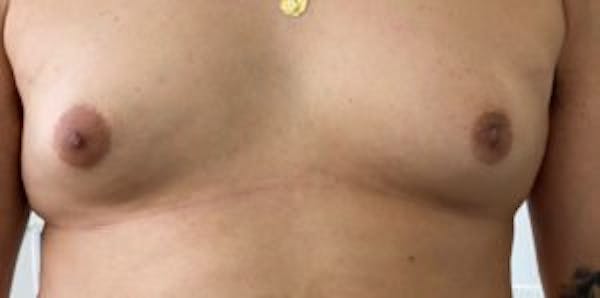 Gynecomastia Before & After Gallery - Patient 33513263 - Image 1