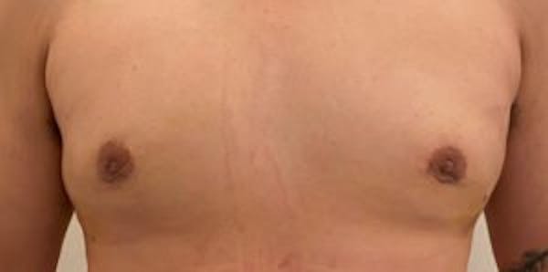 Gynecomastia Before & After Gallery - Patient 33513263 - Image 2