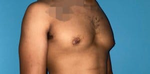 Gynecomastia in Houston Before and After 2