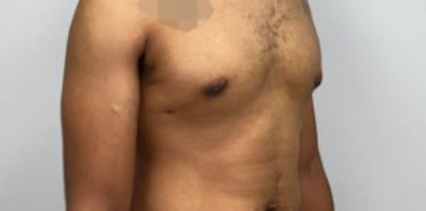 Gynecomastia in Houston Before and After 2