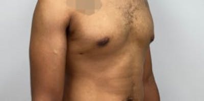 Gynecomastia Before & After Gallery - Patient 33513264 - Image 2