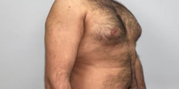 Gynecomastia Before & After Gallery - Patient 33513265 - Image 1