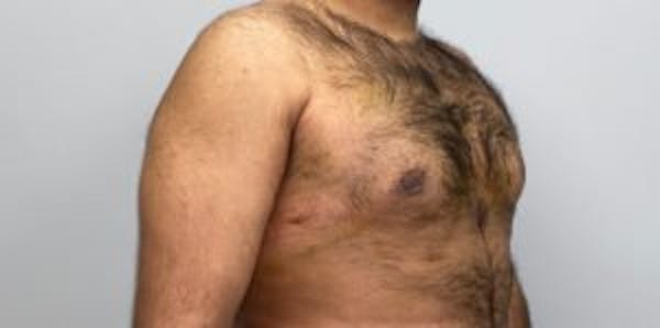 Gynecomastia Before & After Gallery - Patient 33513265 - Image 2