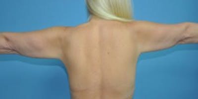 Arm Lift Before & After Gallery - Patient 33514346 - Image 1