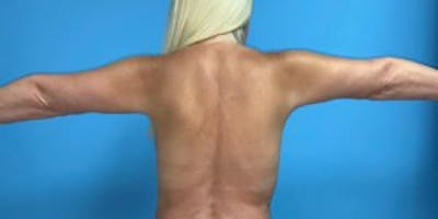 Arm Lift Before & After Gallery - Patient 33514346 - Image 2