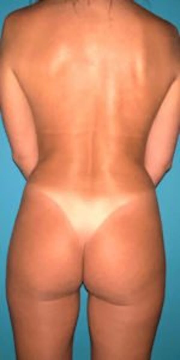 Butt Lift Before & After Gallery - Patient 33514428 - Image 3