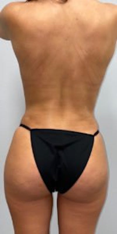 Butt Lift Before & After Gallery - Patient 33514428 - Image 4