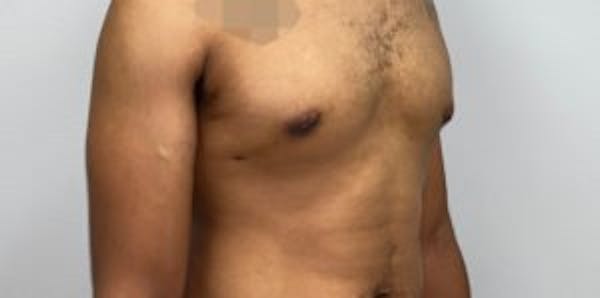 Liposuction Before & After Gallery - Patient 33514450 - Image 2