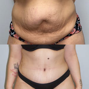 Before and after Liposuction in Houston, TX