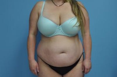 Tummy Tuck Before & After Gallery - Patient 33514492 - Image 1