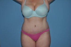 Tummy Tuck in houston, before and after 1