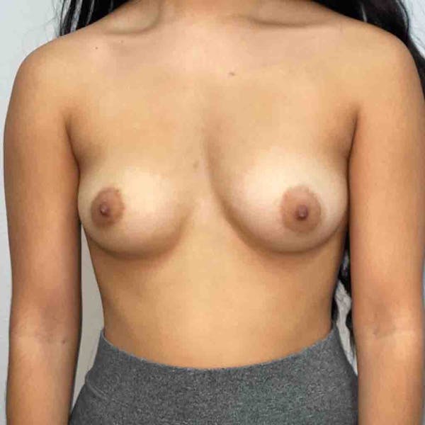 Breast Augmentation Before & After Gallery - Patient 33513195 - Image 1