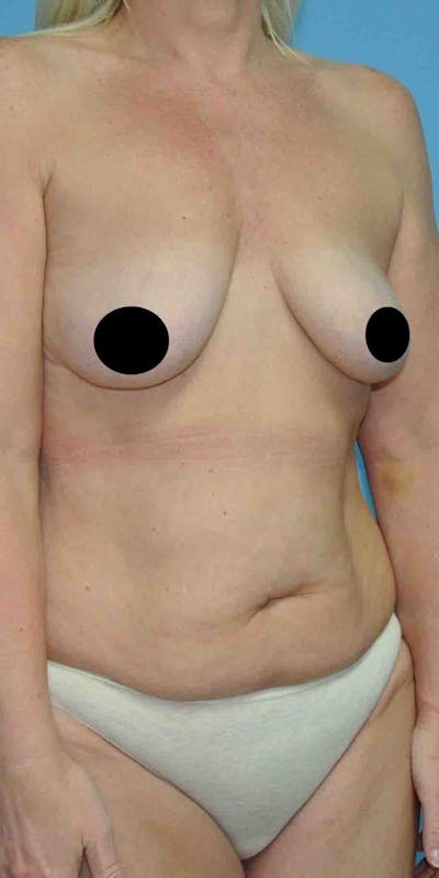Breast Augmentation Before & After Gallery - Patient 33513196 - Image 1