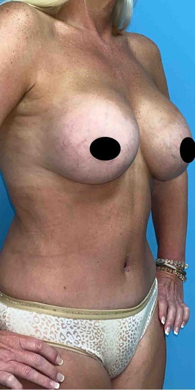 Breast Augmentation Before & After Gallery - Patient 33513196 - Image 2