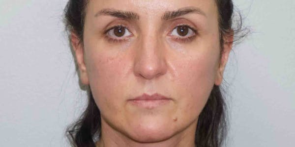 Facelift Before & After Gallery - Patient 33513177 - Image 2