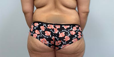 Butt Lift Before & After Gallery - Patient 33514429 - Image 1