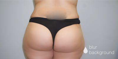 Butt Lift Before & After Gallery - Patient 33514429 - Image 2