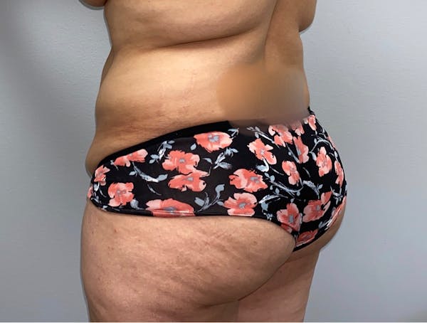 Butt Lift Before & After Gallery - Patient 33514429 - Image 3