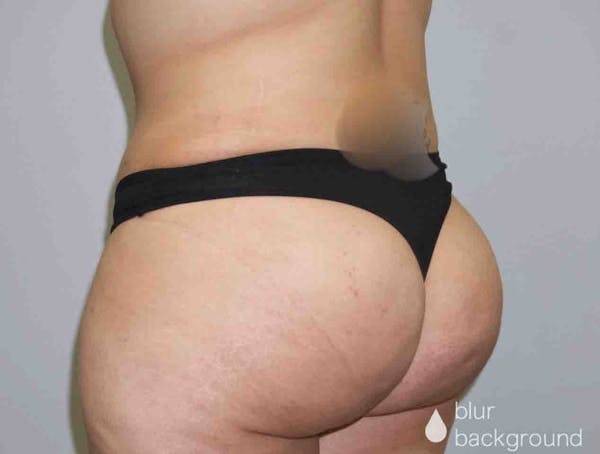 Butt Lift Before & After Gallery - Patient 33514429 - Image 4