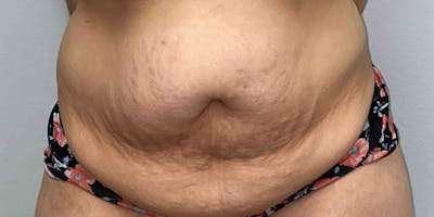 Liposuction Before & After Gallery - Patient 33514453 - Image 1