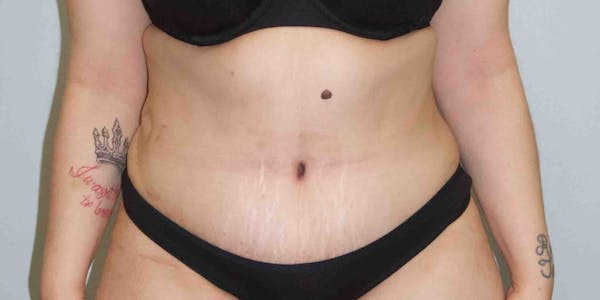 Liposuction Before & After Gallery - Patient 33514453 - Image 2