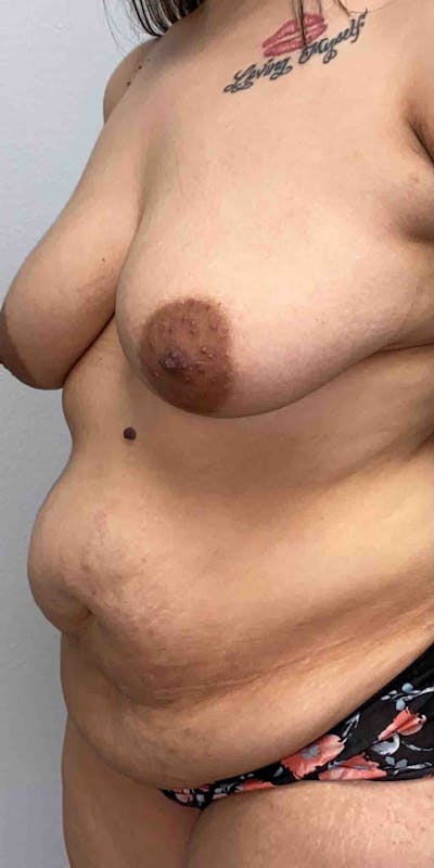 Tummy Tuck Before & After Gallery - Patient 33514493 - Image 1