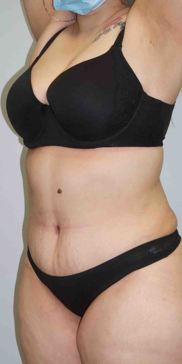 Liposuction Before & After Gallery - Patient 33514453 - Image 4