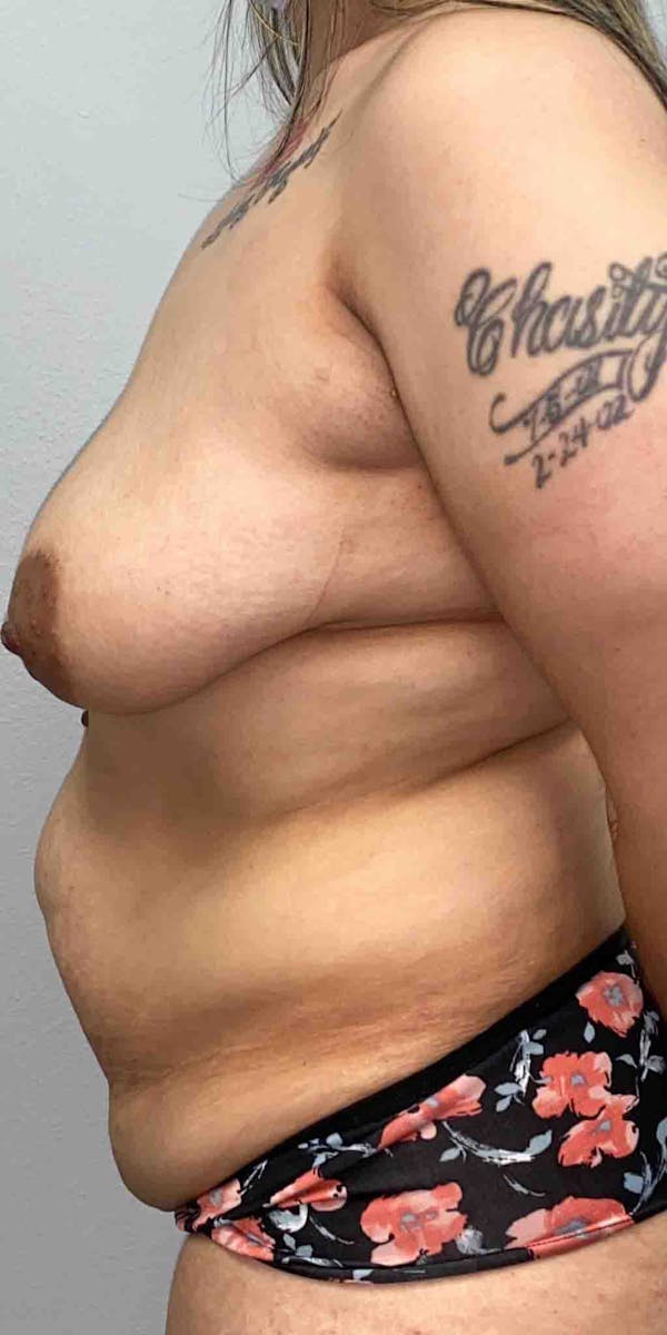 Liposuction Before & After Gallery - Patient 33514453 - Image 5