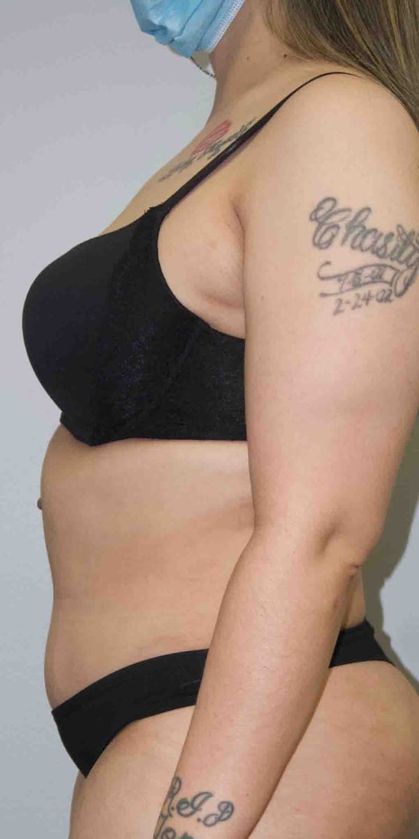 Tummy Tuck Before & After Gallery - Patient 33514493 - Image 4