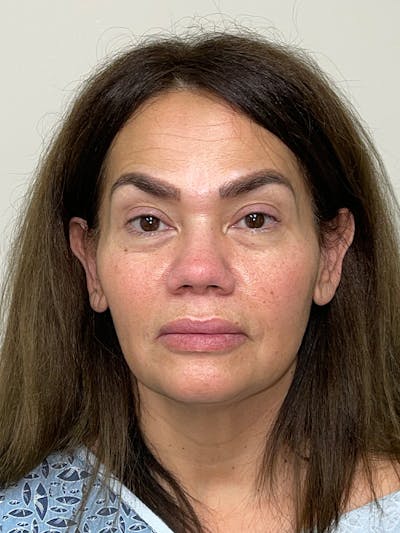 Facelift Before & After Gallery - Patient 44804375 - Image 1