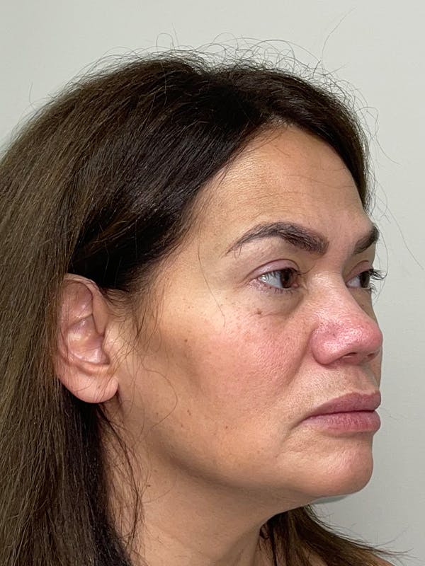 Facelift Before & After Gallery - Patient 44804375 - Image 3