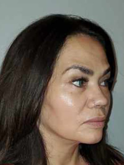 Facelift Before & After Gallery - Patient 44804375 - Image 4