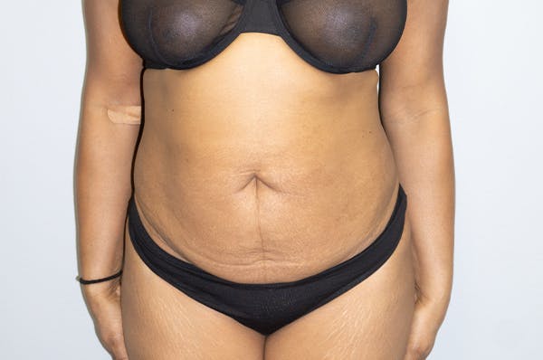 Tummy Tuck Before & After Gallery - Patient 46629382 - Image 1