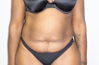 Tummy Tuck Before & After Gallery - Patient 46629383 - Image 1
