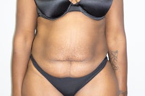 Tummy Tuck in houston, before and after 4