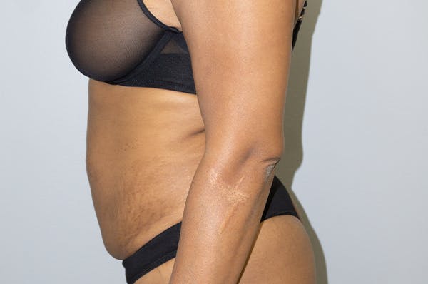 Tummy Tuck Before & After Gallery - Patient 46629382 - Image 3