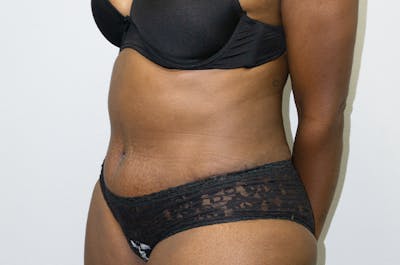 Tummy Tuck Before & After Gallery - Patient 46629383 - Image 4