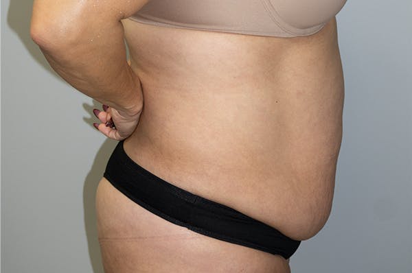 Liposuction Before & After Gallery - Patient 47434518 - Image 3