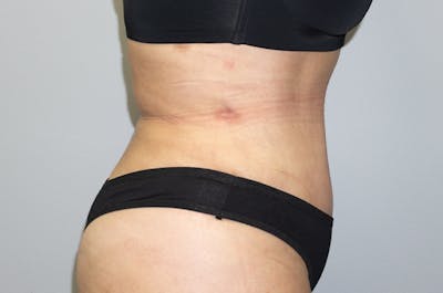 Tummy Tuck Before & After Gallery - Patient 47434578 - Image 4