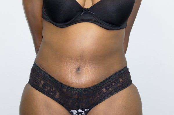 Before and after Liposuction in Houston, TX 2