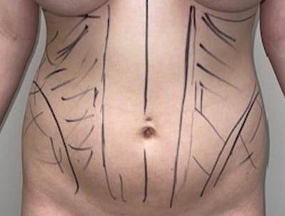 Liposuction Gallery - Patient 46629987 - Image 1