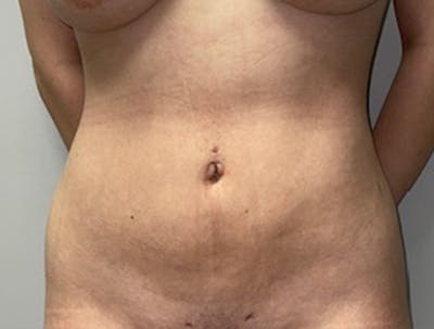 Liposuction Before & After Gallery - Patient 46629987 - Image 2