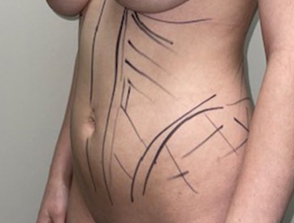 Liposuction Before & After Gallery - Patient 46629987 - Image 3