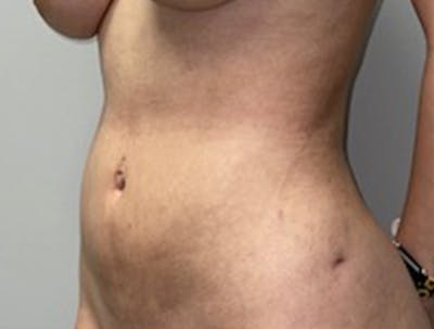 Liposuction Before & After Gallery - Patient 46629987 - Image 4