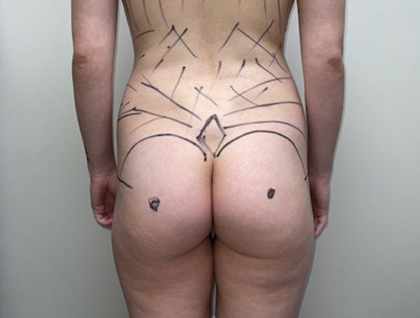 Liposuction Before & After Gallery - Patient 46629987 - Image 5