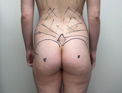 Butt Lift Before & After Gallery - Patient 46630304 - Image 1